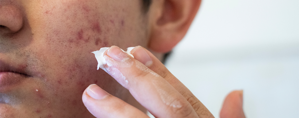 Henkilö levittämässä voidetta akneihollensa