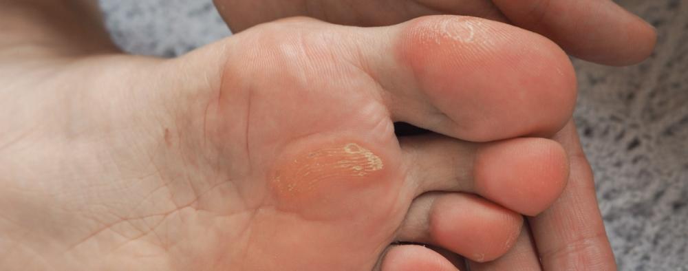 Känsä henkilön jalkapohjassa