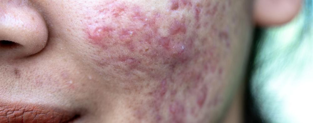Aknen aiheuttamia punoittavia näppylöitä henkilön kasvoilla 