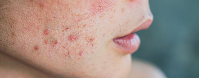 Lähikuva henkilön kasvoista, jolla on punainen ja tulehtunut akne poskessaan.