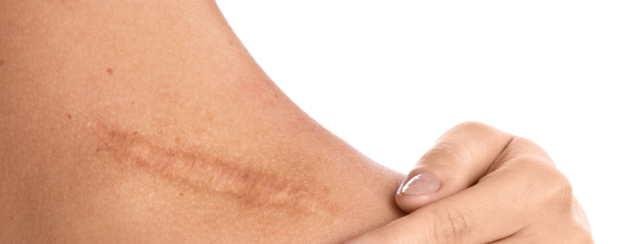 Arpi on ihon paranemista 