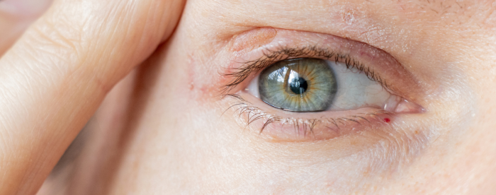 Silm&auml;luomien talipunkit: tunnista oireet ja hoida tehokkaasti