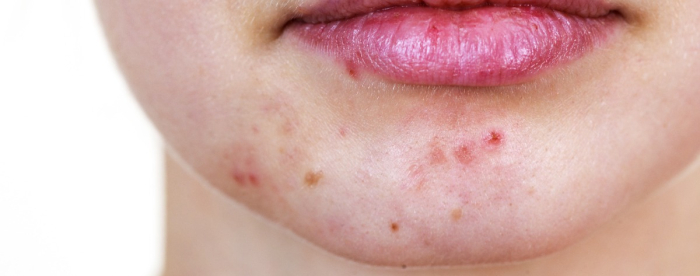 Nuoren naisen kasvoilla leuassa punoittavia finnejä