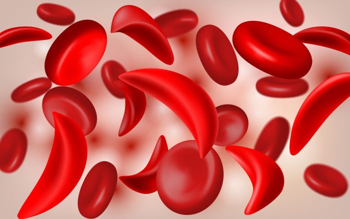 Raudanpuute ja anemia voi ilmetä monenlaisina oireita. Hemoglobiini on rautapitoinen happea sitova molekyyli, joka esiintyy veren punasoluissa.