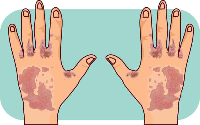 Syyhy – Oireet ja hoito. Käsissä olevaa syyhyn aiheuttaama ihotumaa