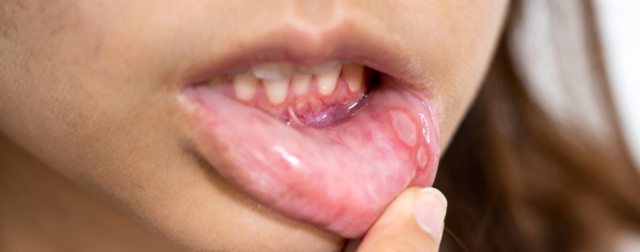 Aftat suussa, mikä auttaa?