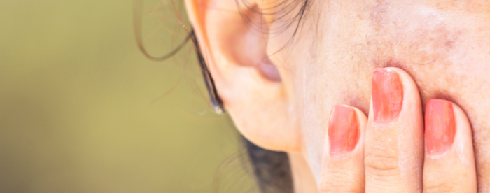 Lähikuva maksaläiskistä henkilön poskella