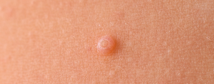 Lähikuva ontelosyylästä iholla