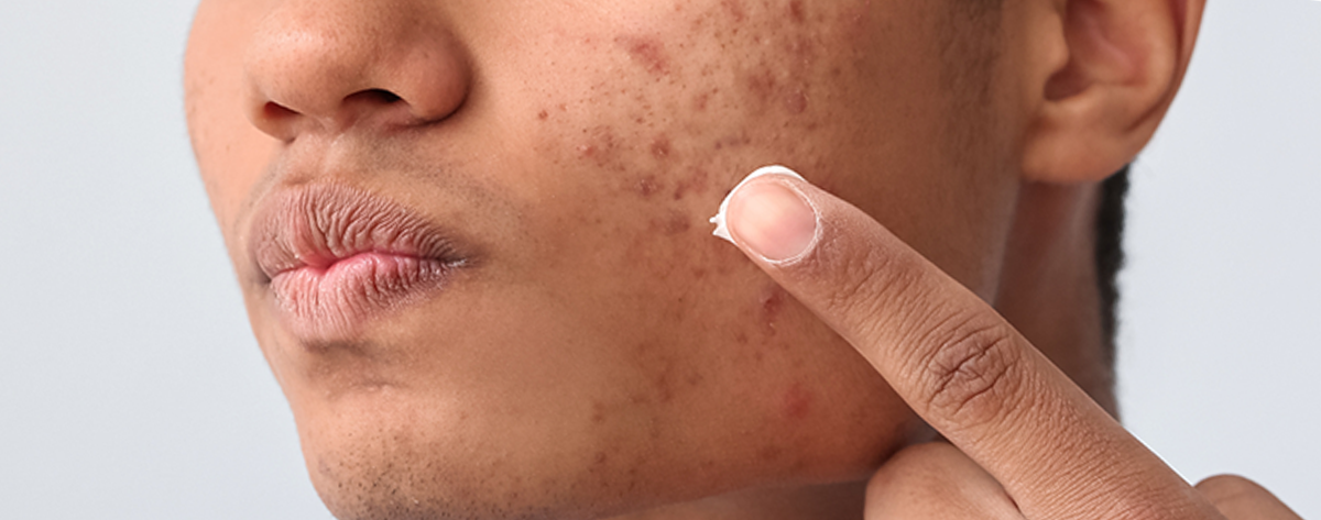 Poskessa oireileva akne, joka näkyy punoituksena ja näppylöinä
