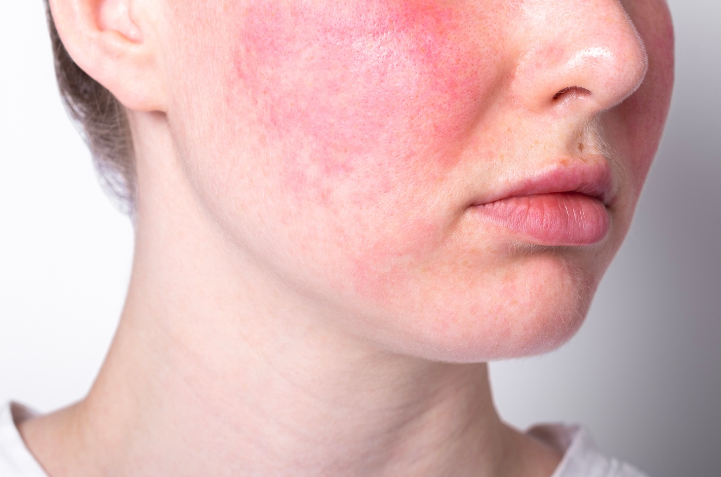 Rosacea eli ruusufinni on yleinen ihotauti. Oireena punainen, ruusuinen iho