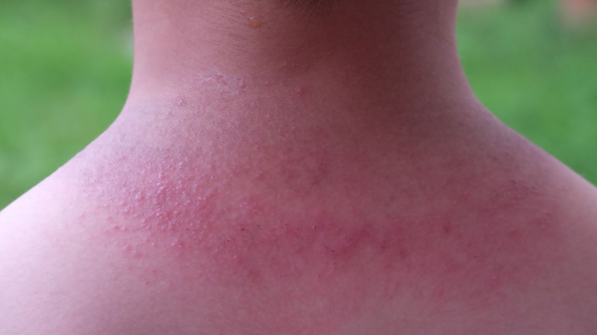 Hikinäppyjä lapsen selässä.