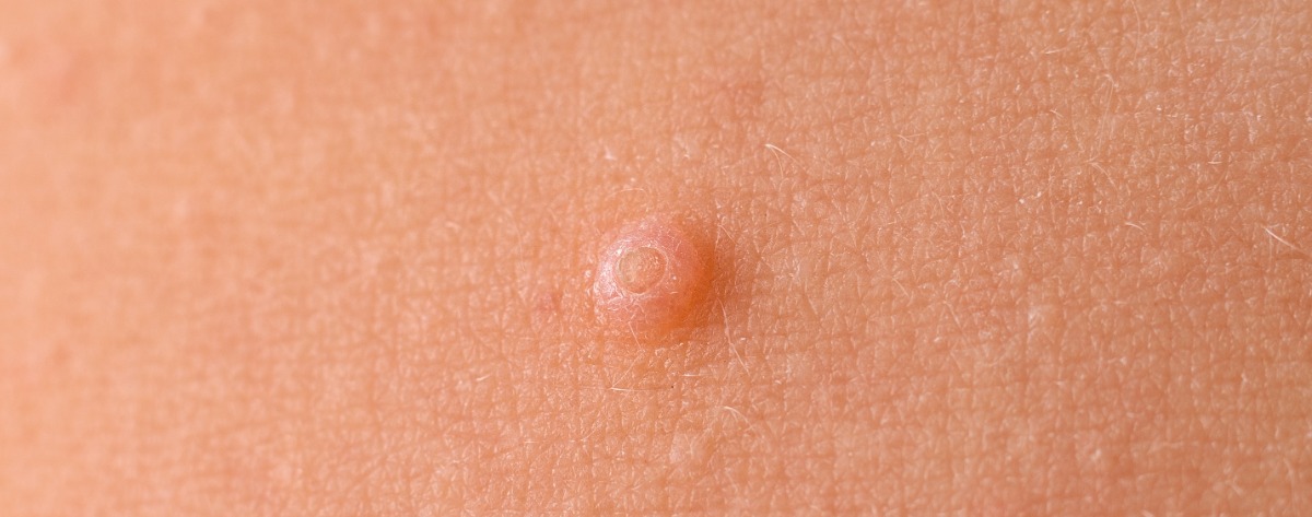 Lähikuva ontelosyylästä iholla